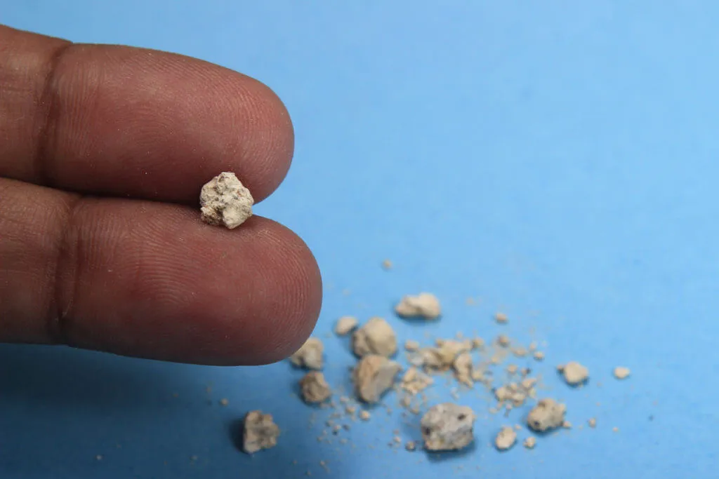 Best Kidney Stone Diet Tips | Lopmudra Hospital’s Specialized Kidney Care