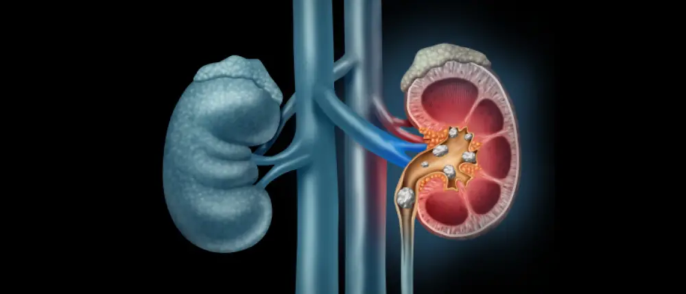 Early Symptoms of Kidney Stones: Lopmudra Hospital’s Guide to Spotting the Signs