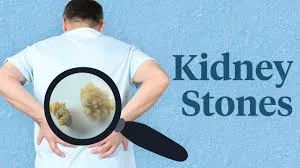 Understanding Kidney Stone Formation: Lopmudra Hospital’s Expert Insights on Causes and Prevention