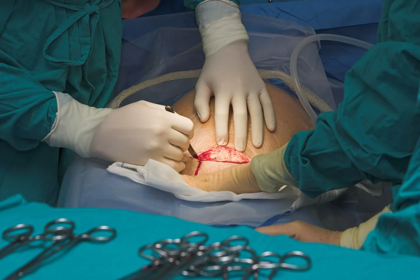 Cesarean Section Guide: Understanding the Procedure, Risks & Recovery at Lopmudra Hospital