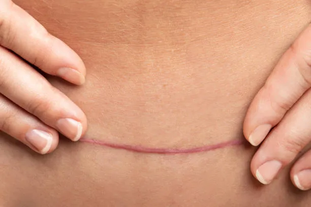 Natural Birth After C-Section: Safe Options & Expert Insights by Lopmudra Hospital