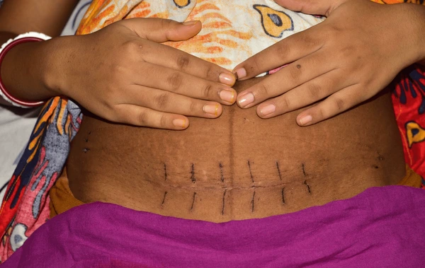Understanding C-Section Stitches: How Many and What to Expect After Delivery