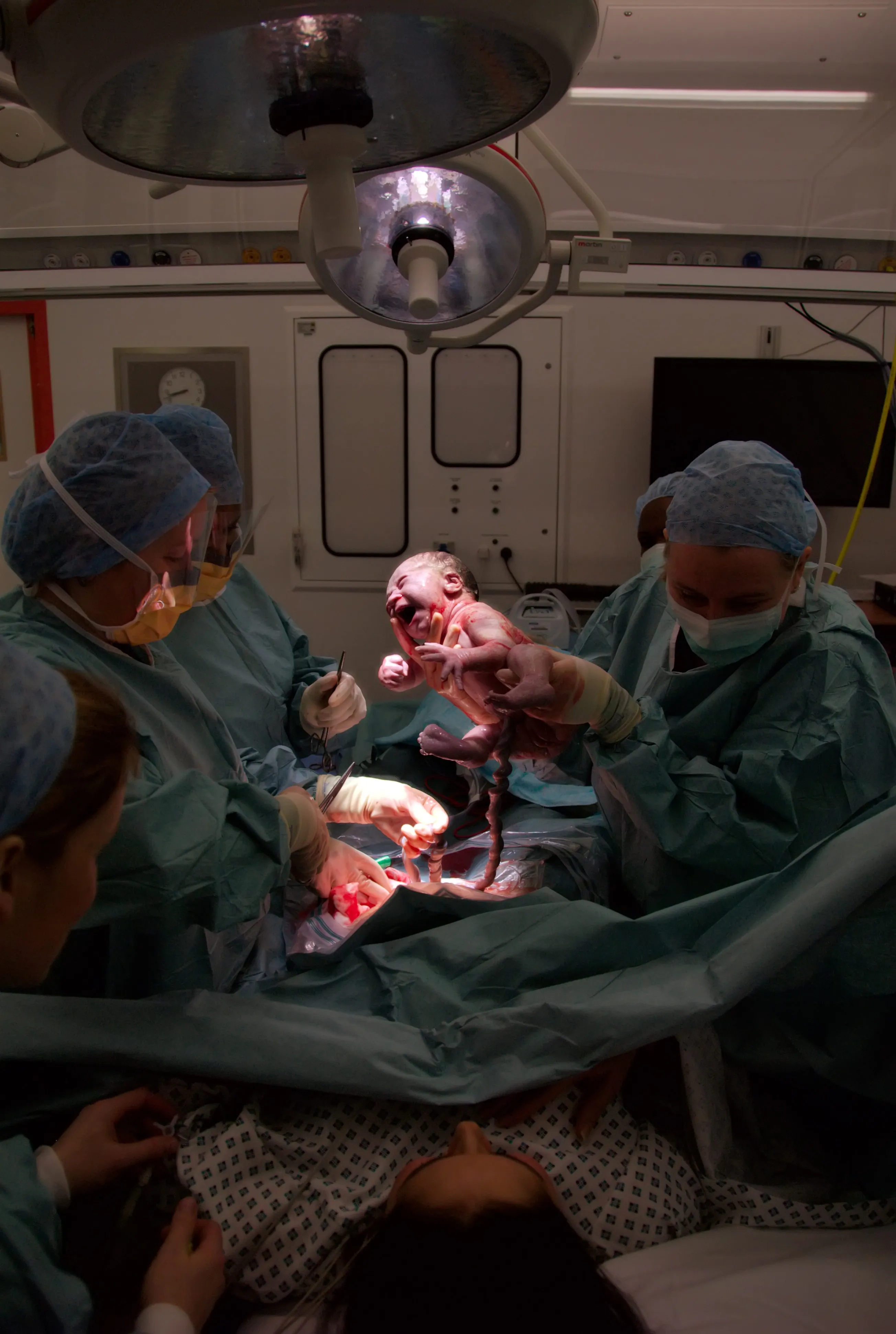 Caesarean Birth Concerns: Understanding the Risks and Benefits at Lopmudra Hospital