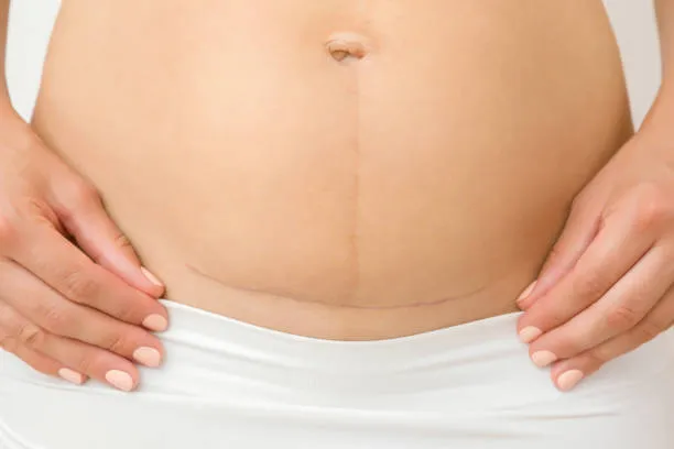 C-Section vs Natural Delivery: Pain Levels Compared – Insights by Lopmudra Hospital