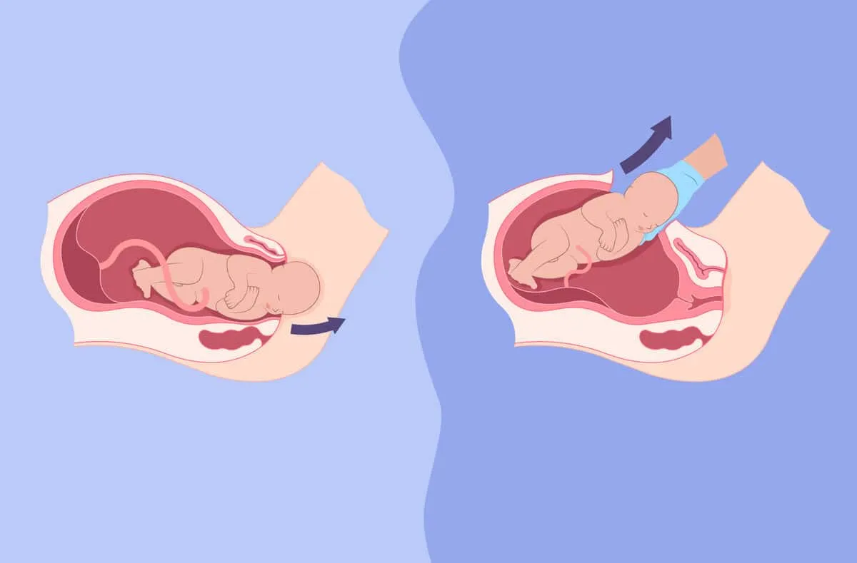 Normal Delivery vs C-Section: Advantages & Benefits at Lopmudra Hospital