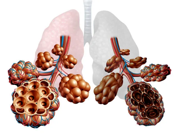 Top COPD & Emphysema Treatments: Expert Care at Lopmudra Hospital Chain