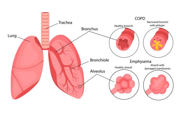 COPD vs Bronchitis: Understanding Key Differences | Lopmudra Hospital Experts